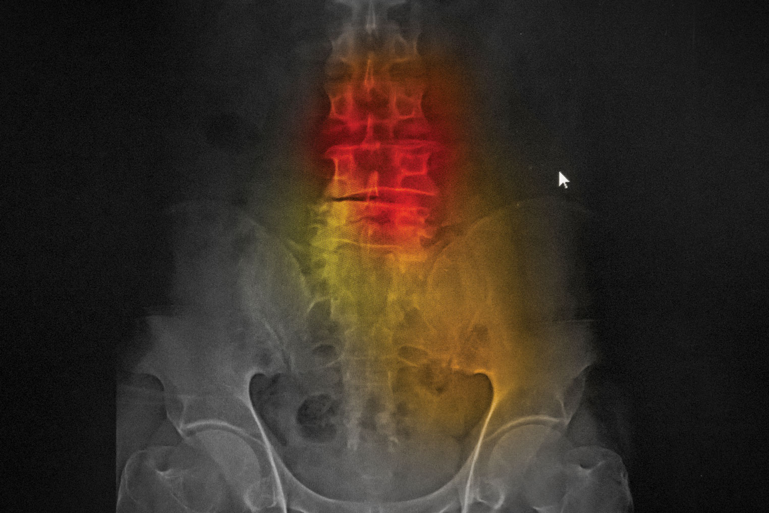 Osteoporosis and Hearing Loss